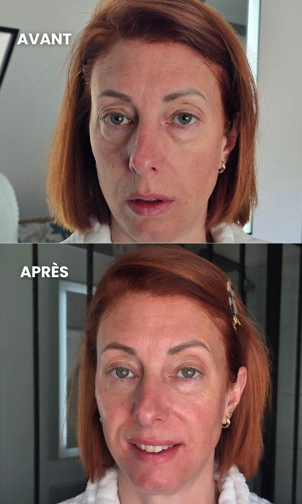 Avant/après de Vanessa utilisant des Ice Globes Method Skin pour décongestionner son visage et réduire les signes de fatigue du regard.