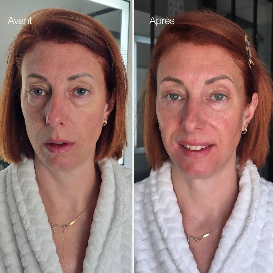 Avant-après ice globes visage Method Skin, visage décongestionné et poches sous les yeux réduites Image