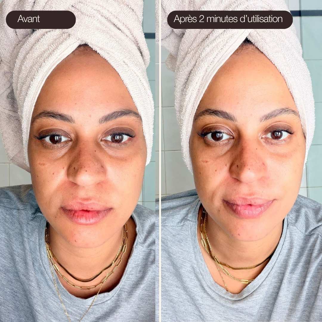 Photo avant-après utilisation des Ice Globes Method Skin montrant un visage décongestionné et des cernes réduites après 2 minutes d’utilisation