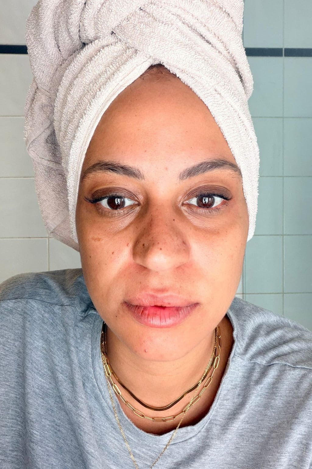 Photo avant utilisation des Ice Globes Method Skin montrant les cernes et le visage congestionné de Marie avant la routine visage